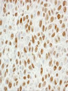 PCNA Antibody - Detection of Mouse PCNA by Immunohistochemistry. Sample: FFPE section of mouse squamous cell carcinoma. Antibody: Affinity purified rabbit anti-PCNA used at a dilution of 1:250. Detection: DAB staining using anti-Rabbit IHC antibody at a dilution of 1:100.