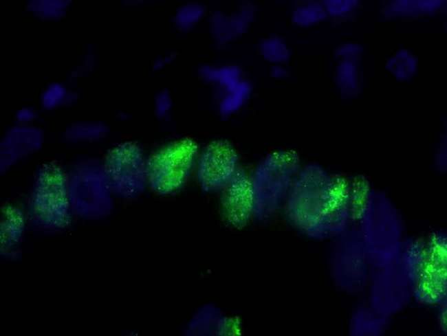 PCNA Antibody - Detection of Human PCNA by Immunofluorescence. Sample: FFPE section of human stomach carcinoma. Antibody: Affinity purified rabbit anti-PCNA used at a dilution of 1:100. Detection: Green-fluorescent Anti-rabbit IgG-FITC conjugated used at a dilution of 1:100.