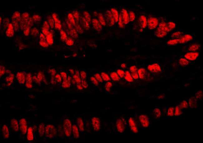 PCNA Antibody - Detection of Human PCNA by Immunofluorescence. Sample: FFPE section of human stomach carcinoma. Antibody: Affinity purified rabbit anti-PCNA used at a dilution of 1:4000 (0.25 ug/ml). Detection: Red-fluorescent Goat anti-Rabbit IgG-heavy and light chain cross-adsorbed Antibody DyLight 594 Conjugated (A120-601D4) used at a dilution of 1:100.