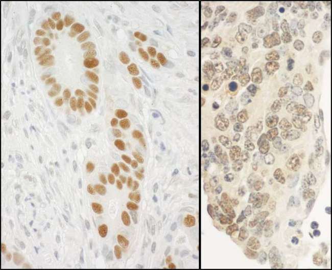 PCNA Antibody - Detection of Human and Mouse PCNA by Immunohistochemistry. Sample: FFPE section of human stomach carcinoma (left) and mouse teratoma (right). Antibody: Affinity purified rabbit anti-PCNA used at a dilution of 1:10000 (0.1 ug/ml). Detection: DAB.