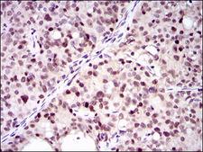PCNA Antibody - IHC of paraffin-embedded cervical cancer tissues using PCNA mouse monoclonal antibody with DAB staining.