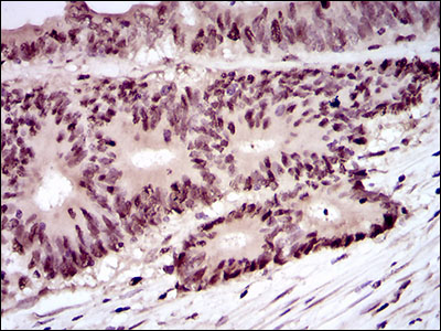 PCNA Antibody - IHC of paraffin-embedded colon cancer tissues using PCNA mouse monoclonal antibody with DAB staining.