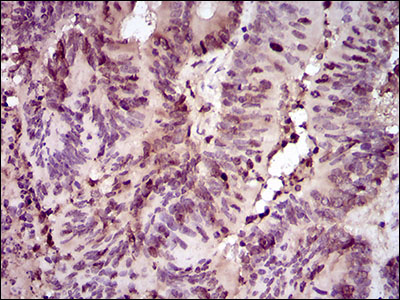 PCNA Antibody - IHC of paraffin-embedded colon cancer tissues using PCNA mouse monoclonal antibody with DAB staining.