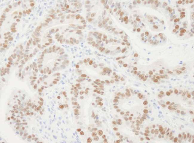 PCNA Antibody - Detection of Human PCNA by Immunohistochemistry. Sample: FFPE section of human stomach carcinoma. Antibody: Affinity purified rabbit anti-PCNA used at a dilution of 1:10000 (0.1 ug/ml). Detection: DAB.