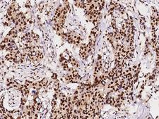 PCNA Antibody - Immunochemical staining of human PCNA in human breast carcinoma with rabbit monoclonal antibody at 1:200 dilution, formalin-fixed paraffin embedded sections.