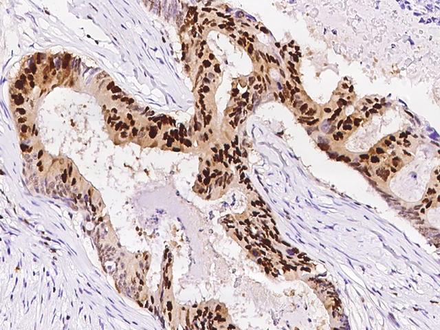 PCNA Antibody - Immunochemical staining of human PCNA in human colon carcinoma with rabbit monoclonal antibody at 1:200 dilution, formalin-fixed paraffin embedded sections.