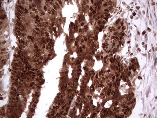 PCNA Antibody - IHC of paraffin-embedded Adenocarcinoma of Human colon tissue using anti-PCNA mouse monoclonal antibody. (Heat-induced epitope retrieval by 1 mM EDTA in 10mM Tris, pH8.5, 120°C for 3min).