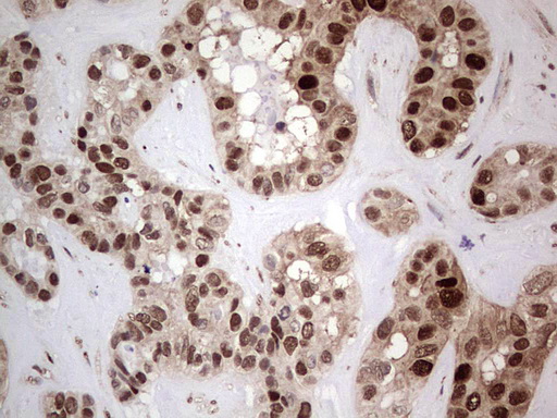 PCNA Antibody - IHC of paraffin-embedded Carcinoma of Human liver tissue using anti-PCNA mouse monoclonal antibody. (Heat-induced epitope retrieval by 1 mM EDTA in 10mM Tris, pH8.5, 120°C for 3min).