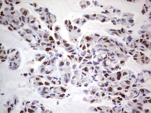 PCNA Antibody - IHC of paraffin-embedded Carcinoma of Human lung tissue using anti-PCNA mouse monoclonal antibody. (Heat-induced epitope retrieval by 1 mM EDTA in 10mM Tris, pH8.5, 120°C for 3min).