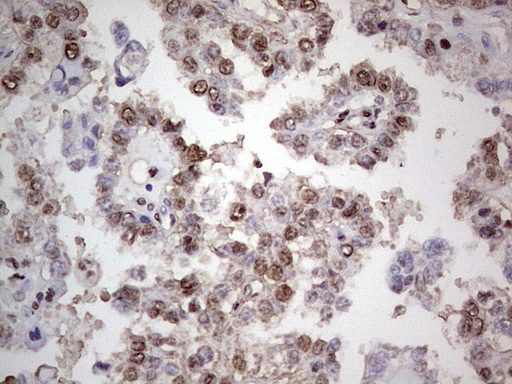 PCNA Antibody - IHC of paraffin-embedded Adenocarcinoma of Human ovary tissue using anti-PCNA mouse monoclonal antibody. (Heat-induced epitope retrieval by 1 mM EDTA in 10mM Tris, pH8.5, 120°C for 3min).