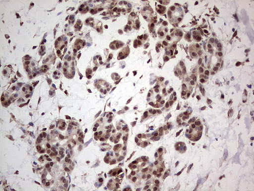 PCNA Antibody - IHC of paraffin-embedded Carcinoma of Human pancreas tissue using anti-PCNA mouse monoclonal antibody. (Heat-induced epitope retrieval by 1 mM EDTA in 10mM Tris, pH8.5, 120°C for 3min).