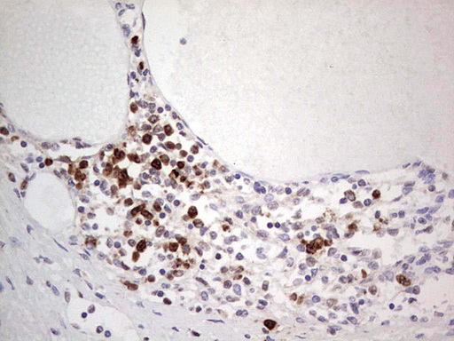 PCNA Antibody - IHC of paraffin-embedded Human thyroid tissue using anti-PCNA mouse monoclonal antibody. (Heat-induced epitope retrieval by 1 mM EDTA in 10mM Tris, pH8.5, 120°C for 3min).