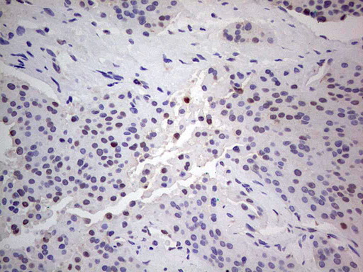 PCNA Antibody - IHC of paraffin-embedded Carcinoma of Human thyroid tissue using anti-PCNA mouse monoclonal antibody. (Heat-induced epitope retrieval by 1 mM EDTA in 10mM Tris, pH8.5, 120°C for 3min).