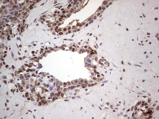 PCNA Antibody - IHC of paraffin-embedded Human prostate tissue using anti-PCNA mouse monoclonal antibody. (Heat-induced epitope retrieval by 1 mM EDTA in 10mM Tris, pH8.5, 120°C for 3min).