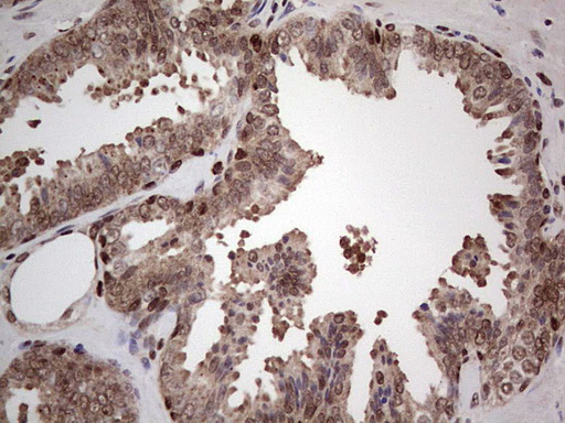 PCNA Antibody - IHC of paraffin-embedded Carcinoma of Human prostate tissue using anti-PCNA mouse monoclonal antibody. (Heat-induced epitope retrieval by 1 mM EDTA in 10mM Tris, pH8.5, 120°C for 3min).