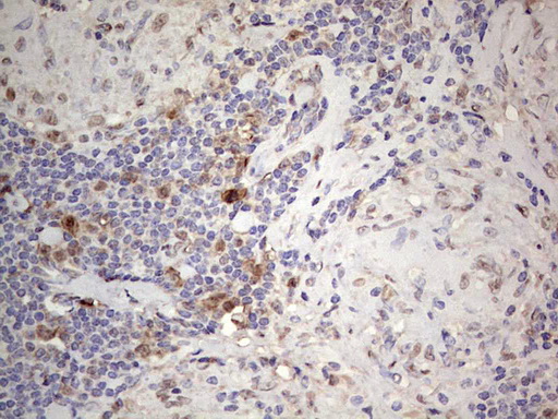 PCNA Antibody - IHC of paraffin-embedded Human lymph node tissue using anti-PCNA mouse monoclonal antibody. (Heat-induced epitope retrieval by 1 mM EDTA in 10mM Tris, pH8.5, 120°C for 3min).