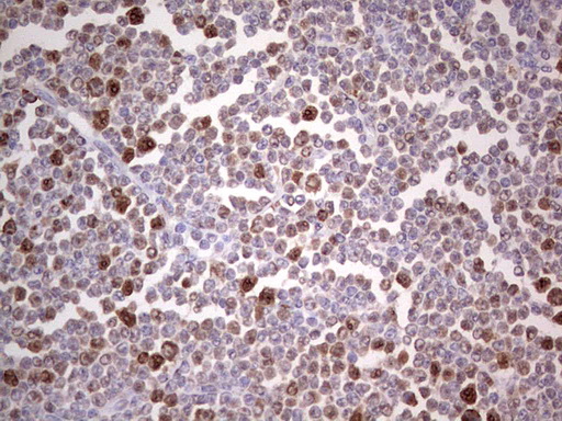 PCNA Antibody - IHC of paraffin-embedded Human lymphoma tissue using anti-PCNA mouse monoclonal antibody. (Heat-induced epitope retrieval by 1 mM EDTA in 10mM Tris, pH8.5, 120°C for 3min).
