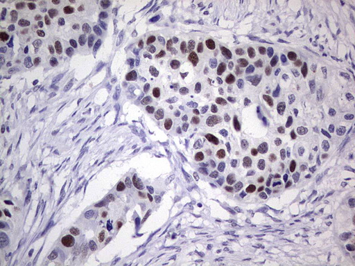 PCNA Antibody - IHC of paraffin-embedded Carcinoma of Human kidney tissue using anti-PCNA mouse monoclonal antibody. (Heat-induced epitope retrieval by 1 mM EDTA in 10mM Tris, pH8.5, 120°C for 3min).
