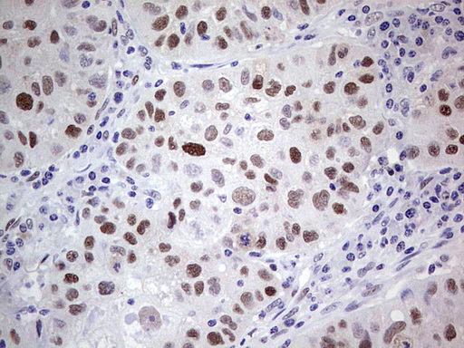 PCNA Antibody - IHC of paraffin-embedded Carcinoma of Human lung tissue using anti-PCNA mouse monoclonal antibody. (Heat-induced epitope retrieval by 1 mM EDTA in 10mM Tris, pH8.5, 120°C for 3min).