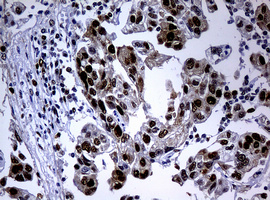 PCNA Antibody - IHC of paraffin-embedded Carcinoma of Human bladder tissue using anti-PCNA mouse monoclonal antibody. (Heat-induced epitope retrieval by 10mM citric buffer, pH6.0, 120°C for 3min).