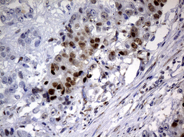 PCNA Antibody - IHC of paraffin-embedded Adenocarcinoma of Human colon tissue using anti-PCNA mouse monoclonal antibody. (Heat-induced epitope retrieval by 10mM citric buffer, pH6.0, 120°C for 3min).
