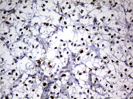 PCNA Antibody - IHC of paraffin-embedded Carcinoma of Human kidney tissue using anti-PCNA mouse monoclonal antibody. (Heat-induced epitope retrieval by 10mM citric buffer, pH6.0, 120°C for 3min).