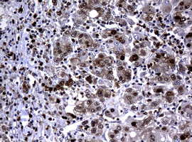 PCNA Antibody - IHC of paraffin-embedded Carcinoma of Human liver tissue using anti-PCNA mouse monoclonal antibody. (Heat-induced epitope retrieval by 10mM citric buffer, pH6.0, 120°C for 3min).