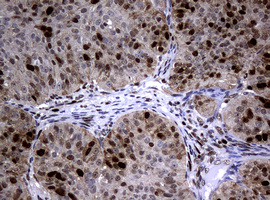 PCNA Antibody - IHC of paraffin-embedded Adenocarcinoma of Human ovary tissue using anti-PCNA mouse monoclonal antibody. (Heat-induced epitope retrieval by 10mM citric buffer, pH6.0, 120°C for 3min).