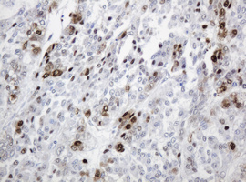 PCNA Antibody - IHC of paraffin-embedded Carcinoma of Human liver tissue using anti-PCNA mouse monoclonal antibody.