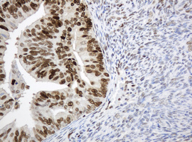 PCNA Antibody - IHC of paraffin-embedded Adenocarcinoma of Human endometrium tissue using anti-PCNA mouse monoclonal antibody.