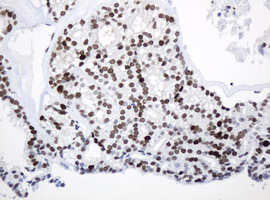 PCNA Antibody - IHC of paraffin-embedded Carcinoma of Human thyroid tissue using anti-PCNA mouse monoclonal antibody.