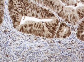 PCNA Antibody - IHC of paraffin-embedded Adenocarcinoma of Human endometrium tissue using anti-PCNA mouse monoclonal antibody.