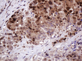 PCNA Antibody - IHC of paraffin-embedded Adenocarcinoma of Human colon tissue using anti-PCNA mouse monoclonal antibody.