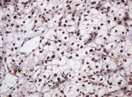 PCNA Antibody - IHC of paraffin-embedded Carcinoma of Human kidney tissue using anti-PCNA mouse monoclonal antibody.