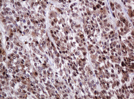 PCNA Antibody - IHC of paraffin-embedded Carcinoma of Human liver tissue using anti-PCNA mouse monoclonal antibody.