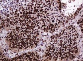 PCNA Antibody - IHC of paraffin-embedded Carcinoma of Human lung tissue using anti-PCNA mouse monoclonal antibody.