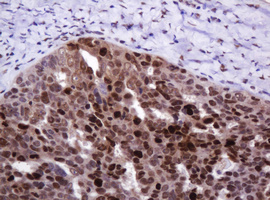 PCNA Antibody - IHC of paraffin-embedded Adenocarcinoma of Human ovary tissue using anti-PCNA mouse monoclonal antibody.