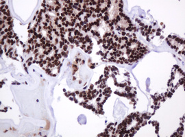PCNA Antibody - IHC of paraffin-embedded Carcinoma of Human thyroid tissue using anti-PCNA mouse monoclonal antibody.