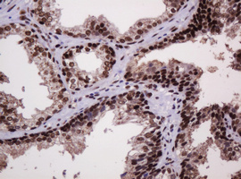 PCNA Antibody - IHC of paraffin-embedded Carcinoma of Human prostate tissue using anti-PCNA mouse monoclonal antibody.