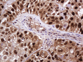 PCNA Antibody - IHC of paraffin-embedded Carcinoma of Human bladder tissue using anti-PCNA mouse monoclonal antibody.
