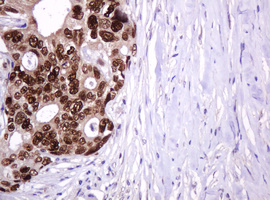 PCNA Antibody - IHC of paraffin-embedded Adenocarcinoma of Human breast tissue using anti-PCNA mouse monoclonal antibody. (Heat-induced epitope retrieval by 10mM citric buffer, pH6.0, 120°C for 3min).