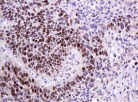 PCNA Antibody - IHC of paraffin-embedded Carcinoma of Human lung tissue using anti-PCNA mouse monoclonal antibody. (Heat-induced epitope retrieval by 10mM citric buffer, pH6.0, 120°C for 3min).