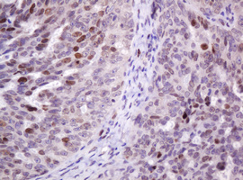 PCNA Antibody - IHC of paraffin-embedded Adenocarcinoma of Human ovary tissue using anti-PCNA mouse monoclonal antibody. (Heat-induced epitope retrieval by 10mM citric buffer, pH6.0, 120°C for 3min).