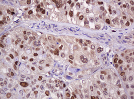 PCNA Antibody - IHC of paraffin-embedded Carcinoma of Human bladder tissue using anti-PCNA mouse monoclonal antibody. (Heat-induced epitope retrieval by 10mM citric buffer, pH6.0, 120°C for 3min).