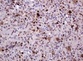 PCNA Antibody - IHC of paraffin-embedded Human lymphoma tissue using anti-PCNA mouse monoclonal antibody. (Heat-induced epitope retrieval by 10mM citric buffer, pH6.0, 120°C for 3min).