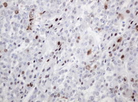 PCNA Antibody - IHC of paraffin-embedded Carcinoma of Human liver tissue using anti-PCNA mouse monoclonal antibody. (Heat-induced epitope retrieval by 10mM citric buffer, pH6.0, 120°C for 3min).