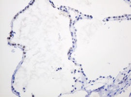 PCNA Antibody - IHC of paraffin-embedded Human thyroid tissue using anti-PCNA mouse monoclonal antibody. (Heat-induced epitope retrieval by 10mM citric buffer, pH6.0, 120°C for 3min).