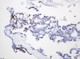 PCNA Antibody - IHC of paraffin-embedded Carcinoma of Human thyroid tissue using anti-PCNA mouse monoclonal antibody. (Heat-induced epitope retrieval by 10mM citric buffer, pH6.0, 120°C for 3min).