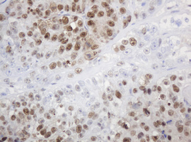 PCNA Antibody - IHC of paraffin-embedded Adenocarcinoma of Human colon tissue using anti-PCNA mouse monoclonal antibody. (Heat-induced epitope retrieval by 10mM citric buffer, pH6.0, 120°C for 3min).