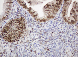 PCNA Antibody - IHC of paraffin-embedded Adenocarcinoma of Human endometrium tissue using anti-PCNA mouse monoclonal antibody. (Heat-induced epitope retrieval by 10mM citric buffer, pH6.0, 120°C for 3min).
